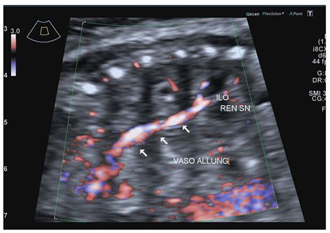 Prenatal Diagnosis of an Intrathoracic Left Kidney Associated with ...