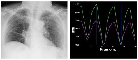 Portable Dynamic Chest Radiography: Literature Review and Potential ...