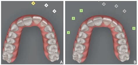 Prosthetically Guided Orthodontics (PGO): A Personalized Clinical ...