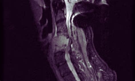 PET/CT technique revolutionizes spinal bone metastases detection in ...