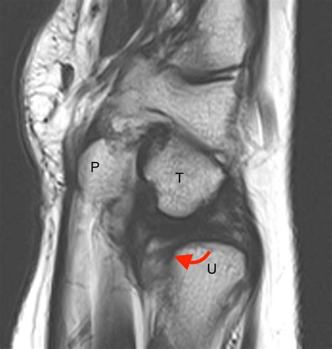 Displaced Triangular Fibrocartilage Cartilage Complex Tears | Radsource