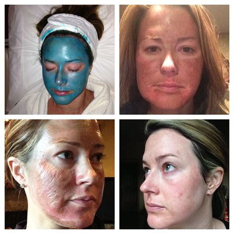 Collection 100+ Pictures Deep Chemical Peel Before And After Photos Completed