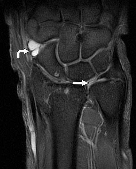 Tfcc Complex Tear Icd 10 | Triangular Fibrocartilage Complex – VZRHJA