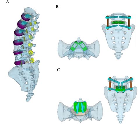 Comparative Biomechanical Analysis of Anterior Lumbar Interbody Fusion ...