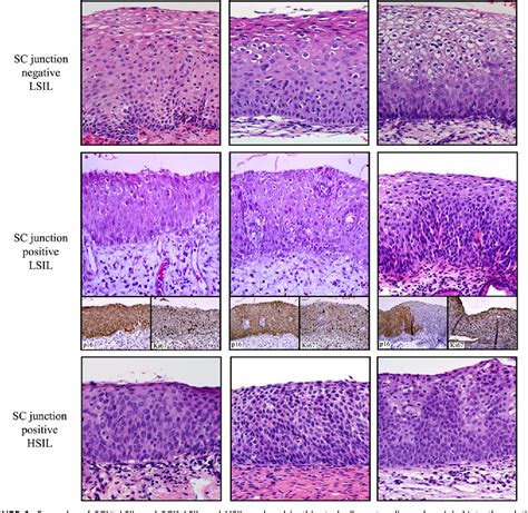 Que Significa Low Grade Intraepithelial Lesion at Brandon Myers blog