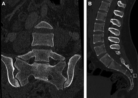 Thoracic and Lumbosacral Spine Anatomy - Neuroimaging Clinics