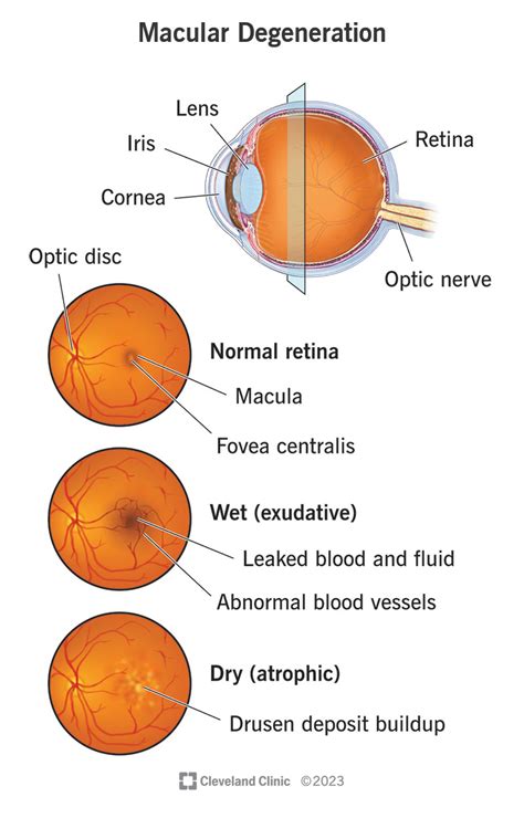 Image result for Macular Degeneration Example