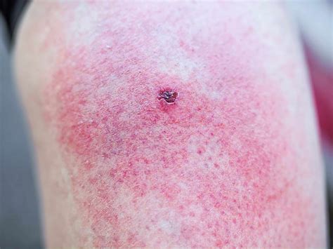 Identifying Insect Bites and Stings: A Guide to Bites | STC
