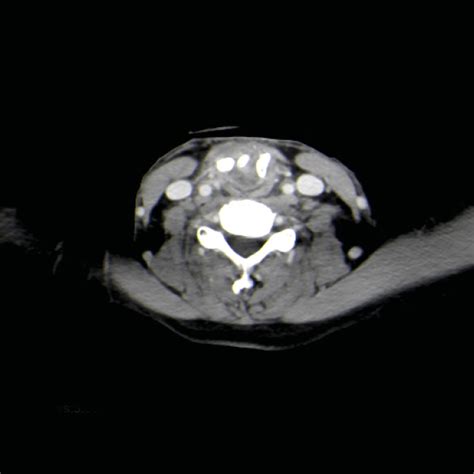Update Radionekrose im Kopf-Hals-Bereich - HNO - Universimed - Medizin ...