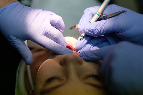 Image result for Surgically Remove Tooth