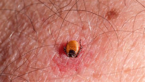 Image result for Embedded Deer Tick