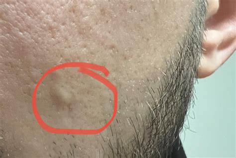 Raised bump on cheek for 7 years : r/DermatologyQuestions