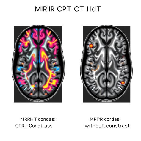 Mri Brain Without Contrast