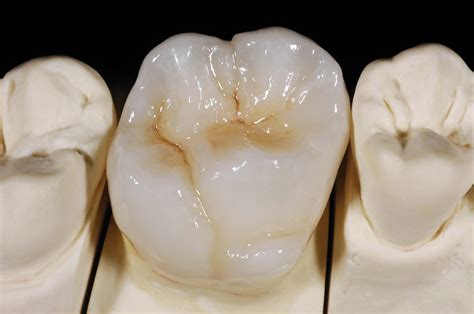 full-zirconia-crown