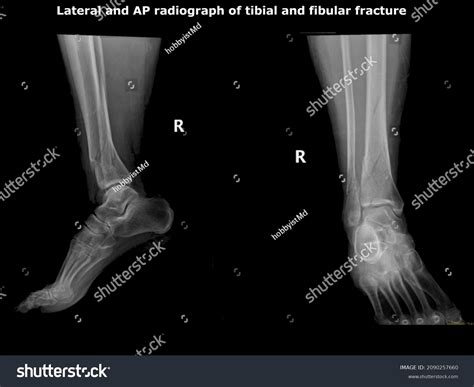 Fibula And Tibia Broken
