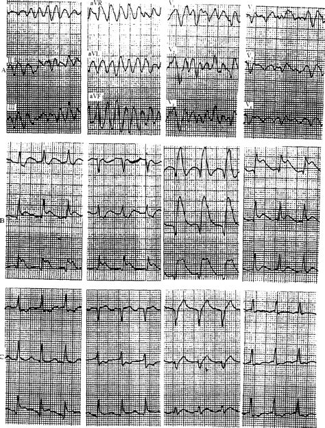 (二) 心房颤动-临床心电图-医学