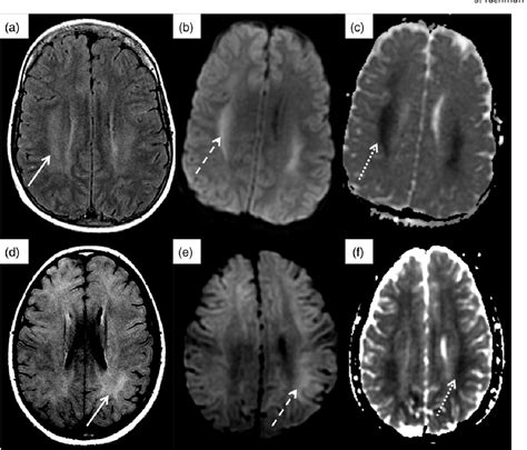 Figure 3 from Dialysis disequilibrium syndrome occurring during ...