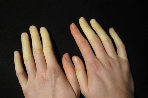 What is Raynaud’s Phenomenon?