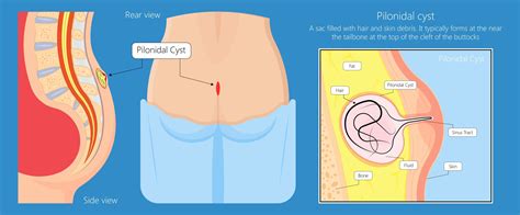 Primordial Cyst Tailbone
