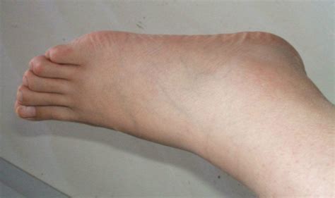 【图】左脚踝肿是什么原因导致的 几个病因你要了解_伊秀健康|yxlady.com