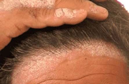 Psoriasis of Scalp | Dr. Aditi's Homeopathy Hair Clinic
