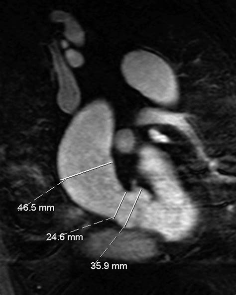 What Is New in Dilatation of the Ascending Aorta? | Circulation