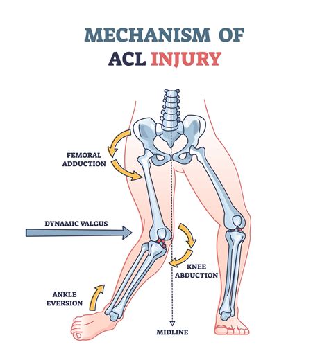 ACL Injury Calgary — Precision Performance & Wellness - Calgary ...