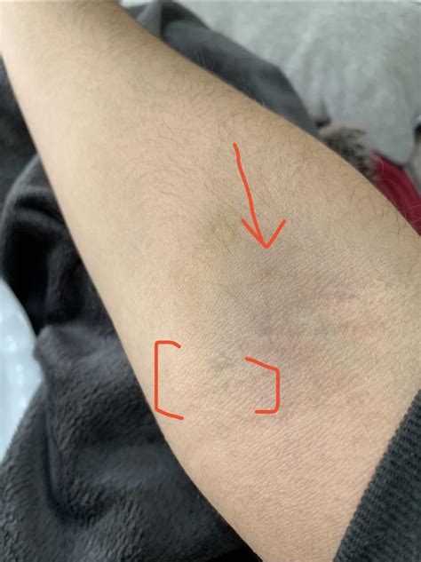 Feels like sore clump of nerves after 2 bad blood draws (bracket area ...