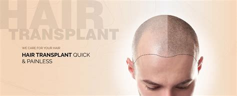 India's no 1 Hair Transplant Clinic located in Gurgaon | AKS Clinic
