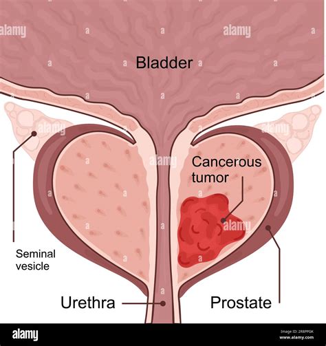 Prostate Cancer 的图像结果