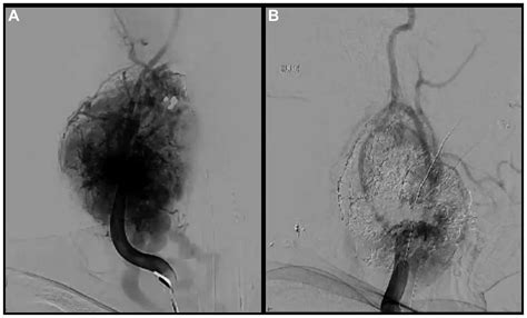Five-year outcome of a staged giant Shamblin type III carotid body tumor excision - Journal of ...