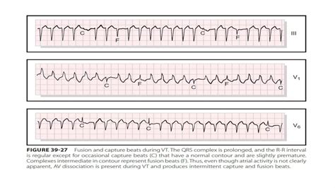 Approach to qrs wide complex tachycardias copy | PPTX | Heart and ...
