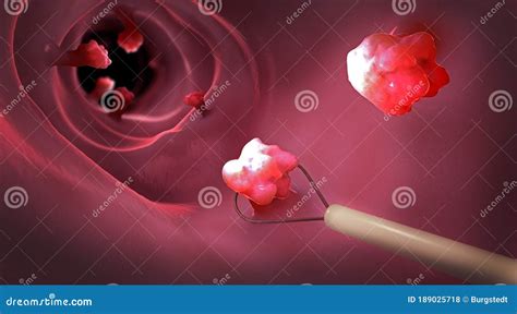 Image result for Loop Colonoscopy