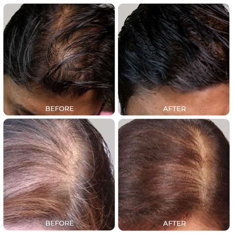 Satthwa Vardhana Hair Oil - DHT Blocker Hair Oil For Hair Regrowth