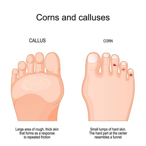Painful Corn In Toe? Learn About At Home Care & Evidence-Based Podiatry ...