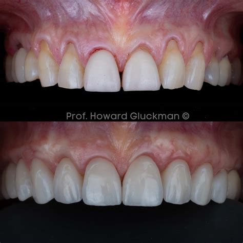 Sculpting Smiles - Periodontal Plastic Surgery