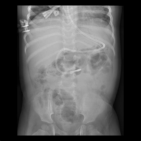 Toddler after feeding tube placement | Pediatric Radiology Case | Pediatric Imaging ...