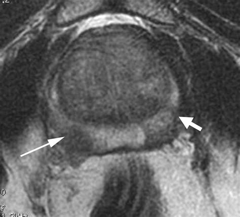 MRI of Prostate Cancer at 1.5 and 3.0 T: Comparison of Image Quality in ...