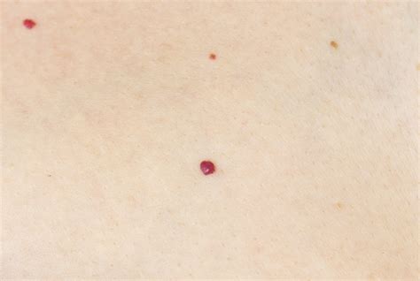 Cherry Angioma Removal Toronto at Loren Bona blog