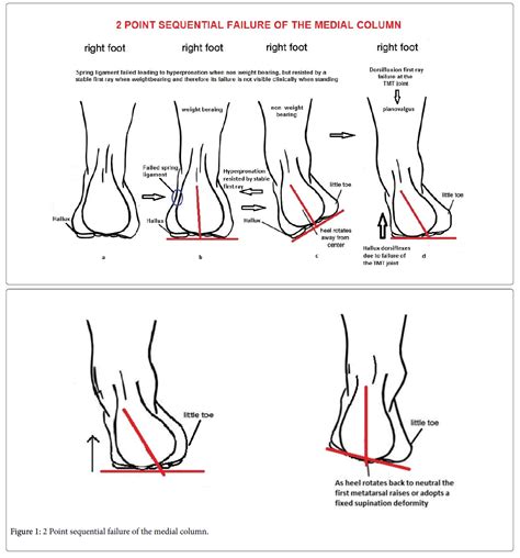 Varus Vs Valgus