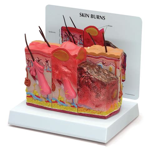 Buy GPI Anatomicals - Skin Burn Model | Human Body Anatomy Replica of ...