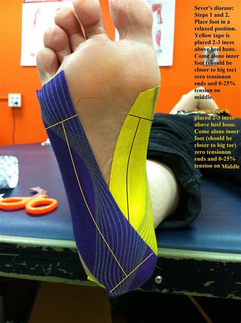 stretches for sever's disease Sever disease treatment exercises ...