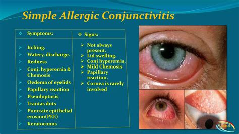Conjunctivitis | PPTX