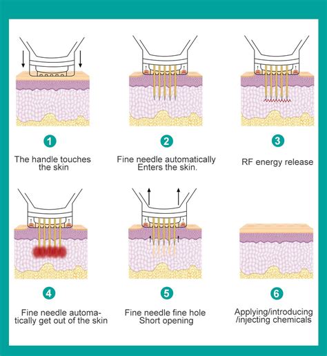 Effect and function of gold microneedle
