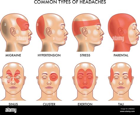 Types Of Headaches And Location