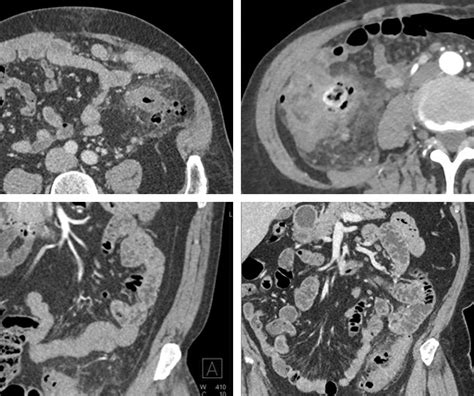 Image result for Colonic Diverticulum CT
