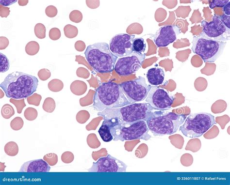 Marginal Zone Lymphoma In Bone Marrow. Cytology. Royalty-Free Stock Photography | CartoonDealer ...