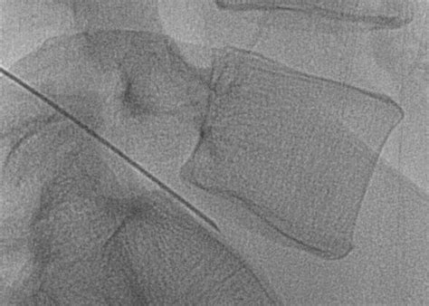 Image result for Disco Injection