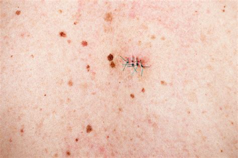 Local excision - Melanoma Focus