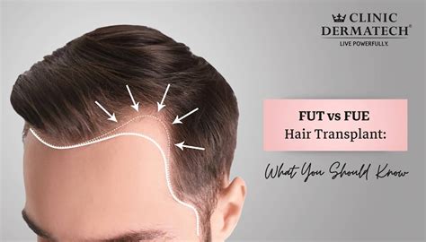 FUE vs. FUT Hair Transplants | Austin Hair Restoration Clinic